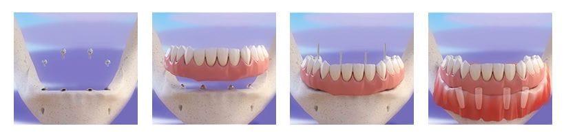 AN ALL-ON-4 DENTAL IMPLANT TREATMENT