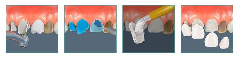 About Porcelain Veneers in Brooklyn