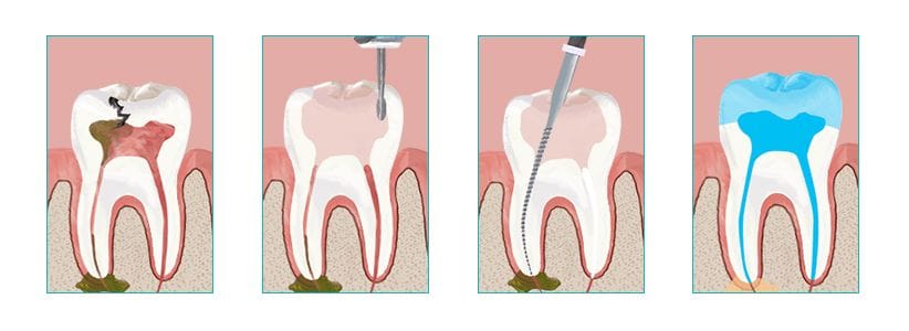 root canal procedure