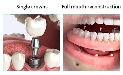 tooth implant types