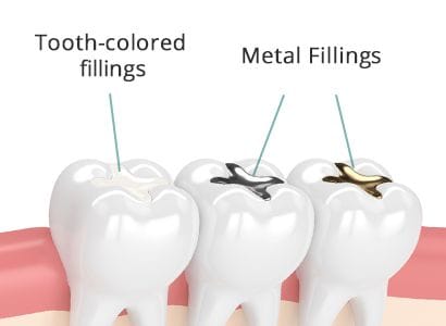 Tooth Colored Fillings vs Metal Fillings Brooklyn