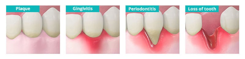 Periodontal Disease Prevention in Brooklyn