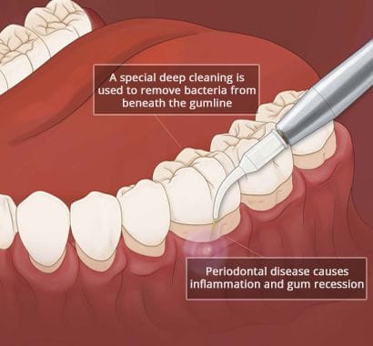 advanced periodontal disease