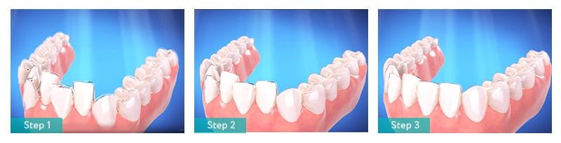 Understanding How Invisalign Works Brooklyn