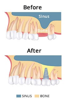 The Sinus Lift Procedure in Brooklyn