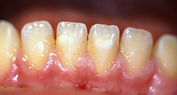 Dental Plaque | Hygienist in Brooklyn NY