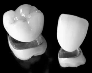 PFM Crowns | Porcelain Fused to Metal Crowns