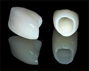 Pfz Crowns | Porcelain Fused to Zirconia Dental Crown