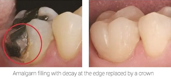 Amalgam Filling Replaced with a Dental Crown