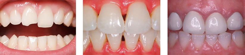 chipped cracked gaps teeth veneers brooklyn ny