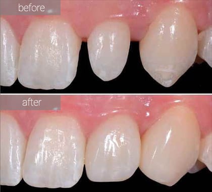 How Much Is Porcelain Veneers In Uk