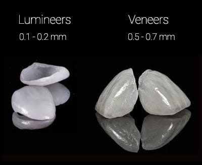 lumineers vs veneers