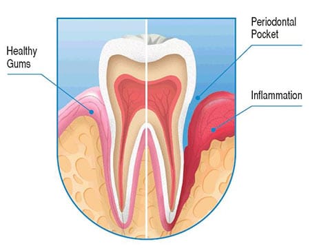 Tooth Sensitivity Treatment in Brooklyn - LuxDen Dental Center