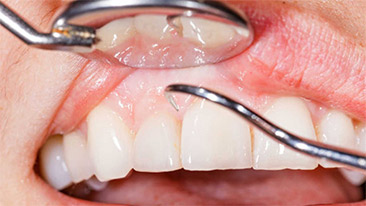 periodontal pockets | Hygienist in Brooklyn NY