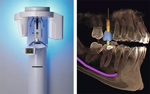 3-D imaging system for dental implants