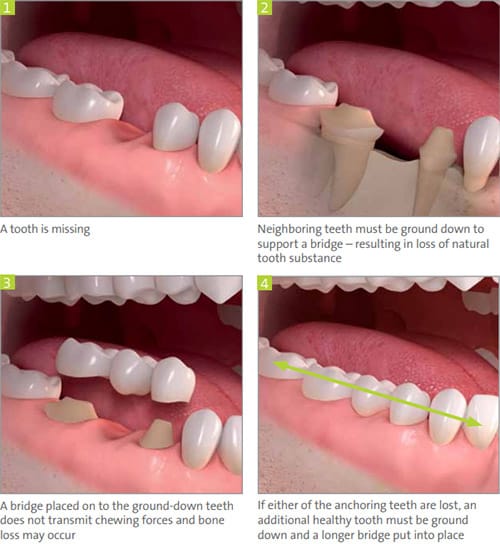 Benefits of Dental Implants  LuxDen Implants Center Brooklyn NY