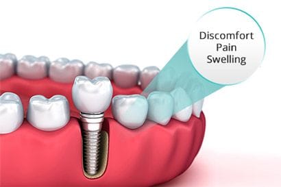 Discomfort after Dental Implant Surgery