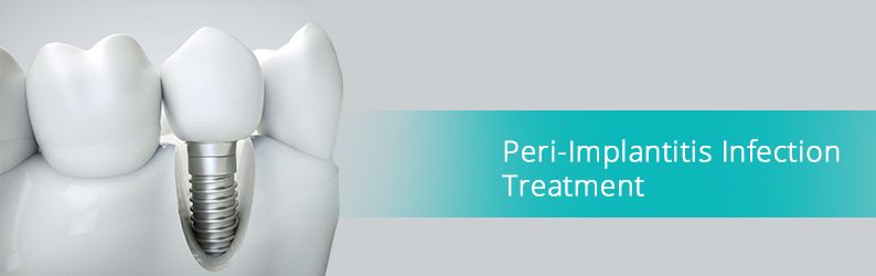 Peri-Implantitis Infection Treatment in Brooklyn