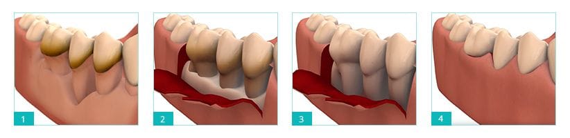 Pocket Reduction Surgery in Brooklyn