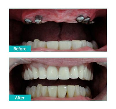 tooth implant before after