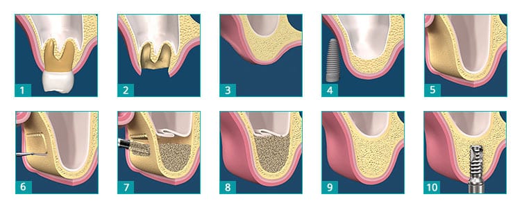 Sinus Lift Surgery for Dental Implants in Brooklyn