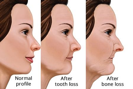 The Effect Of Losing Teeth 