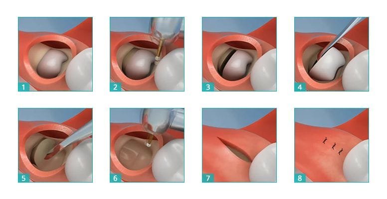 Wisdom Tooth Extractions Procedure Step By Step Infographic