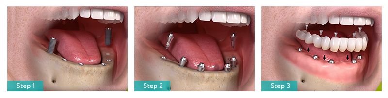 Full Mouth Implants (All on 6) in Brooklyn