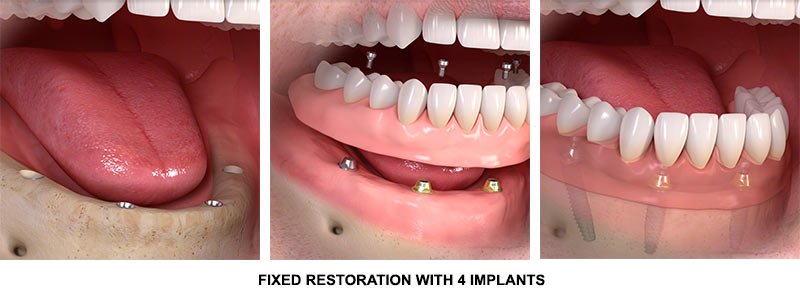 dental implants all on 4 four Brooklyn NY