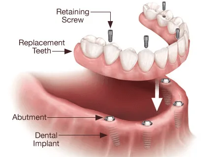 Denture Implants in Brooklyn NY