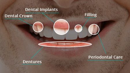 Full Mouth Reconstruction