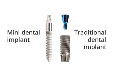 Mini Dental Implants in Brooklyn NY