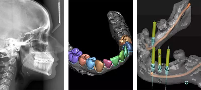 Planning Software for Dental Implants