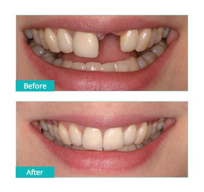 Single Tooth Implants (Traditional Dental Implant) in Brooklyn
