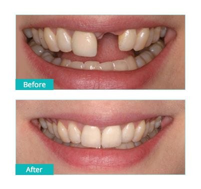 tooth implant before after