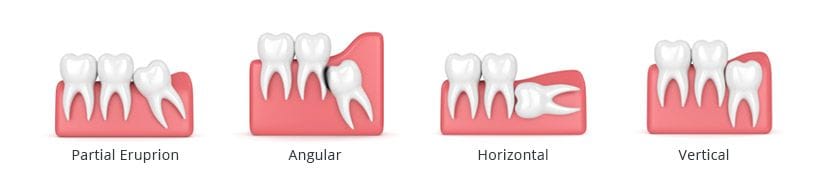 Wisdom Teeth Extraction in Brooklyn