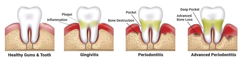 Peri Implantitis Stages | lupon.gov.ph