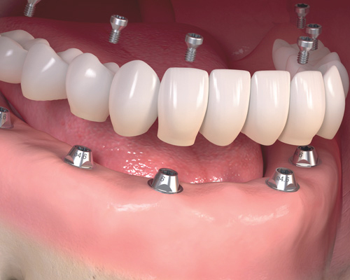 all on 6 dental Implants procedure Brooklyn