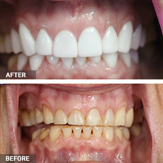 Cosmetic Gingivectomy