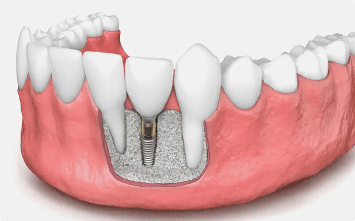 Bone Grafts Dental Bone Grafting Brooklyn, NY