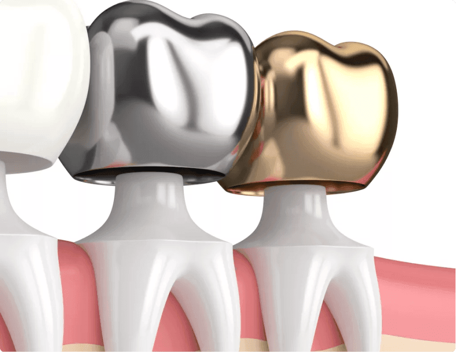Dental Crowns Brooklyn CEREC, PFZ, Zirconium, Ceramic Crowns