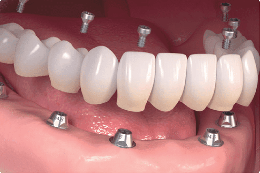 Full Mouth Dental Implants Brooklyn, NY Allon6 Dental Implants