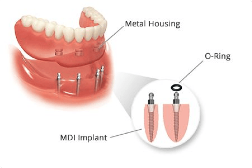 Mini Dental Implants LuxDen Dental Implants Center Brooklyn NY