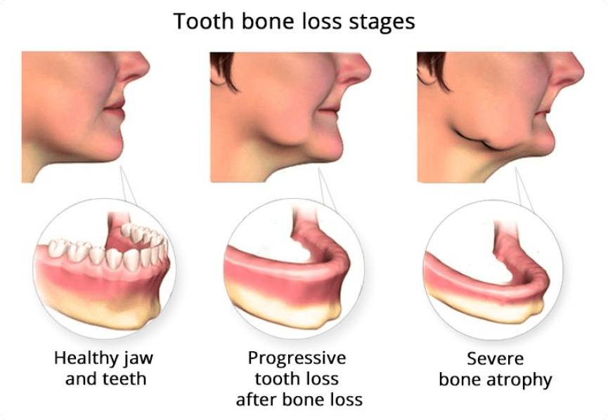 Tooth bone loss stages