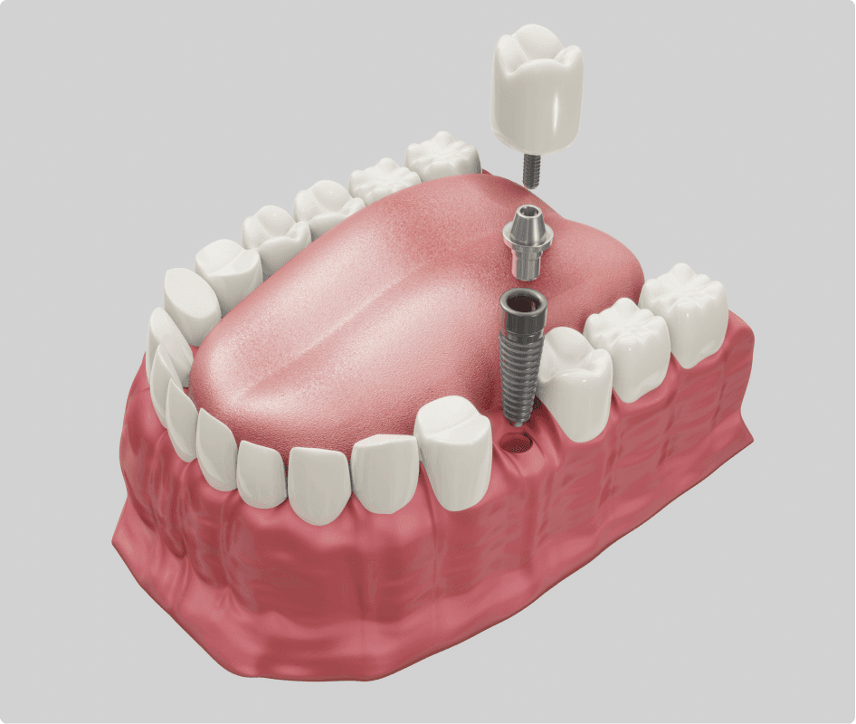 Front Tooth Implant | Dental Implant Front Tooth in Brooklyn NY