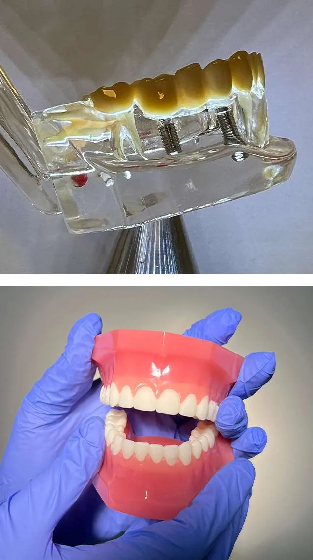 All-on-4 Dental Implants