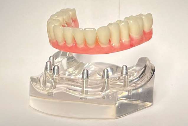 Full Mouth Dental Implants - All-on-6