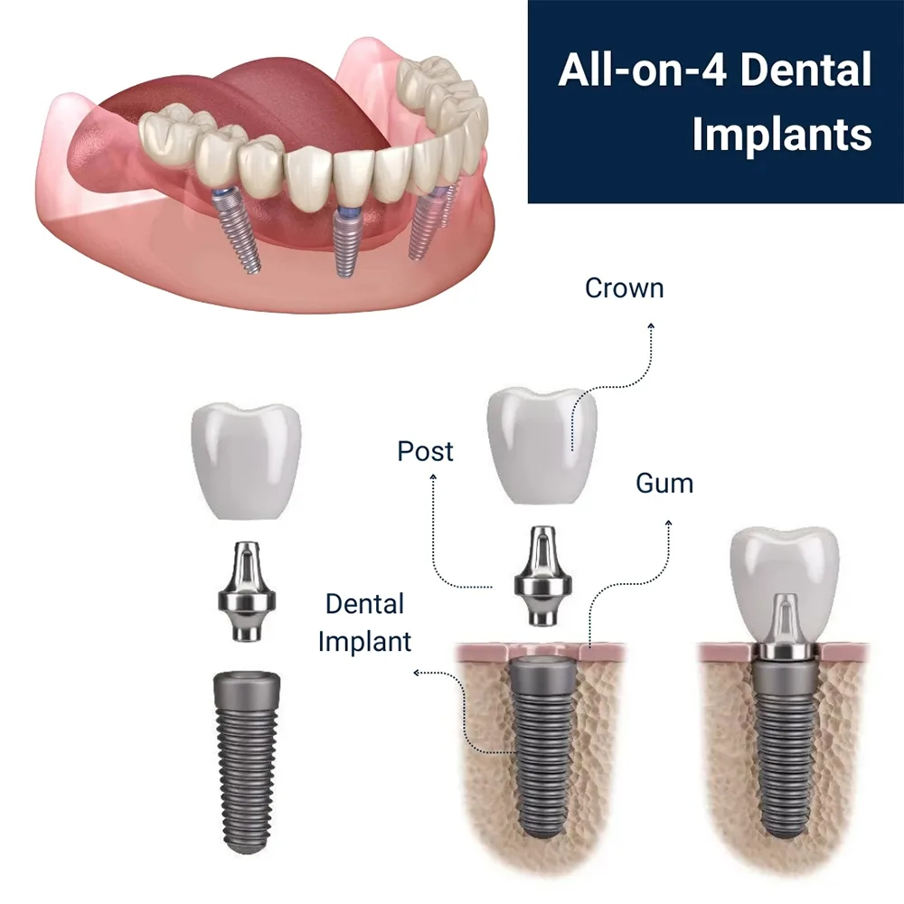 All-on-4 Dental Implants Procedure