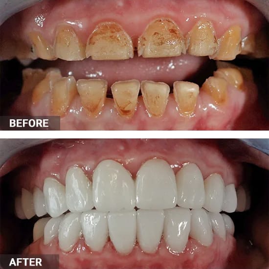 Dental Bonding Before and After