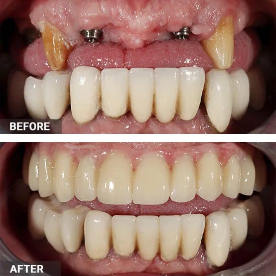 Dental Implant Bridge Before and After
